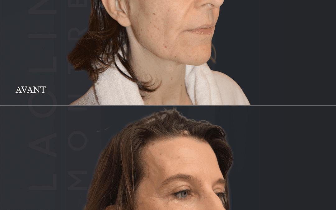 Lifting visage