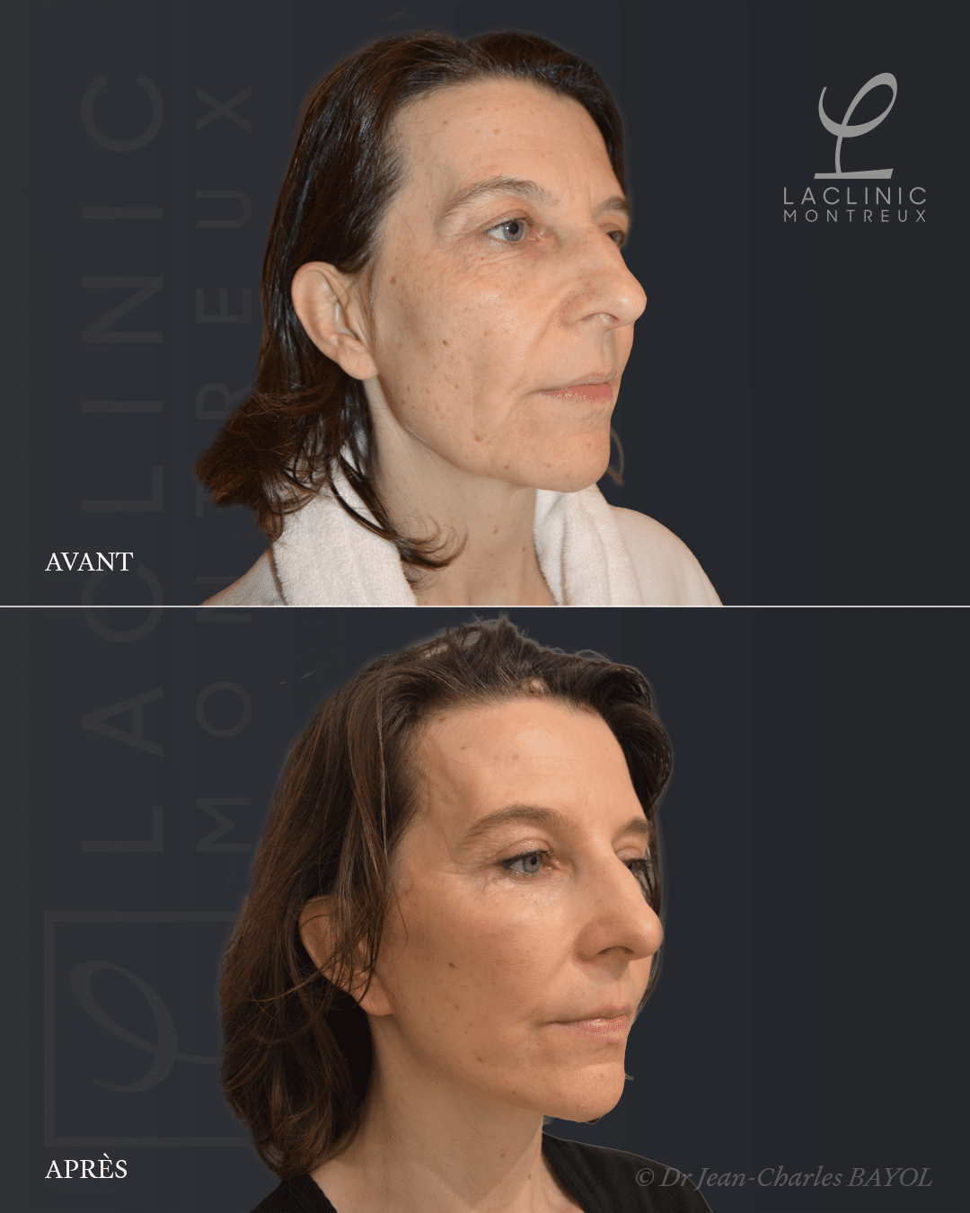 Deep plane facelifting avant-après