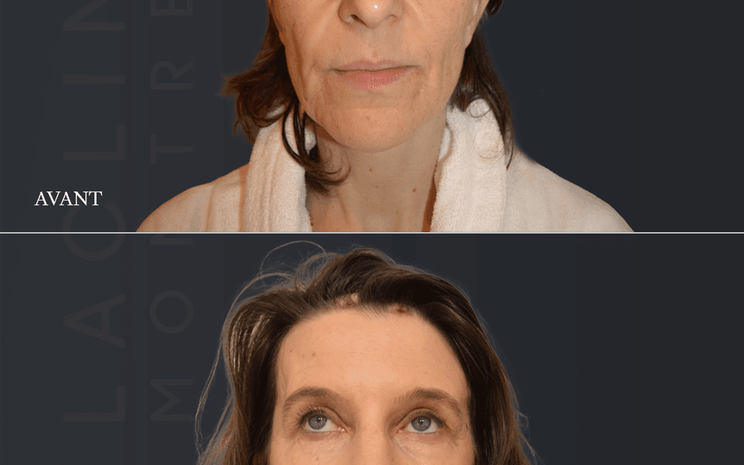 Lifting visage