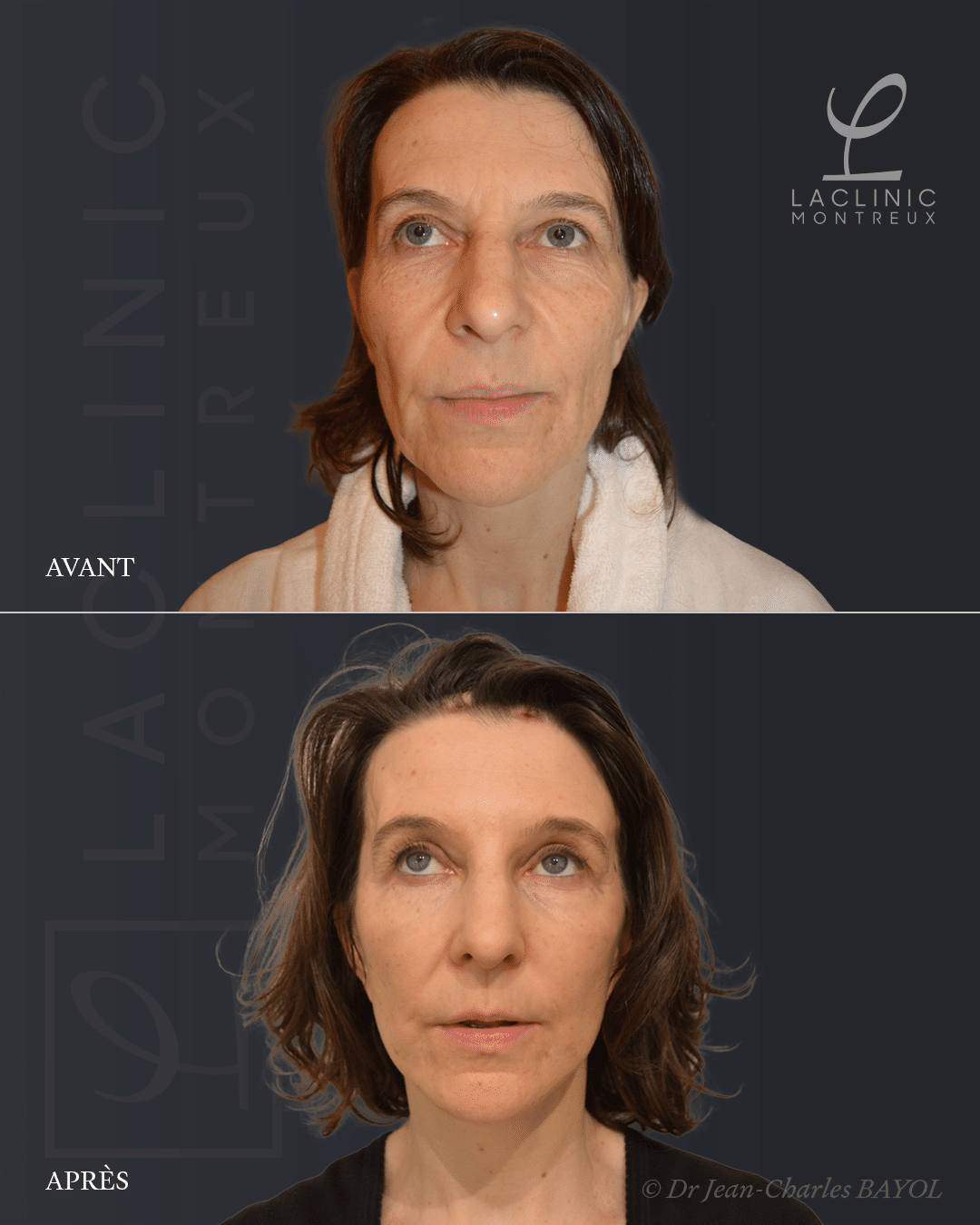 Deep plane facelifting avant-après