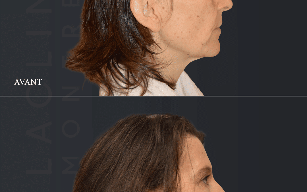 Lifting visage