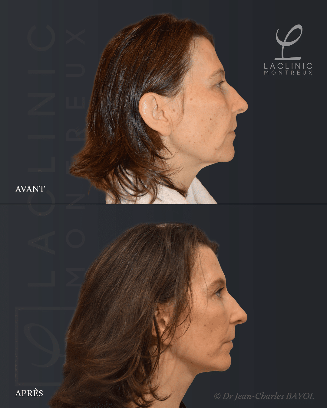 Deep plane facelifting avant-après