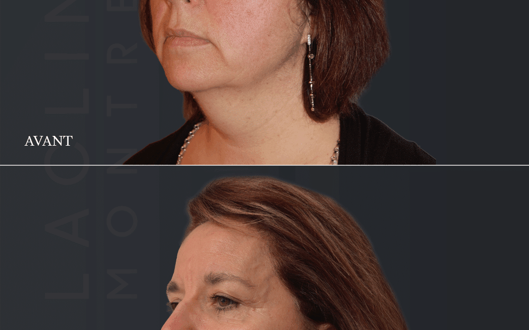 Lifting visage
