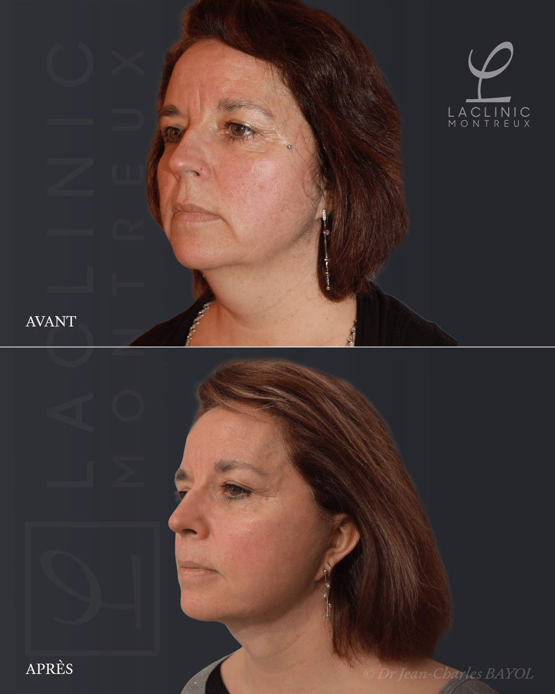 Deep plane facelifting avant-après