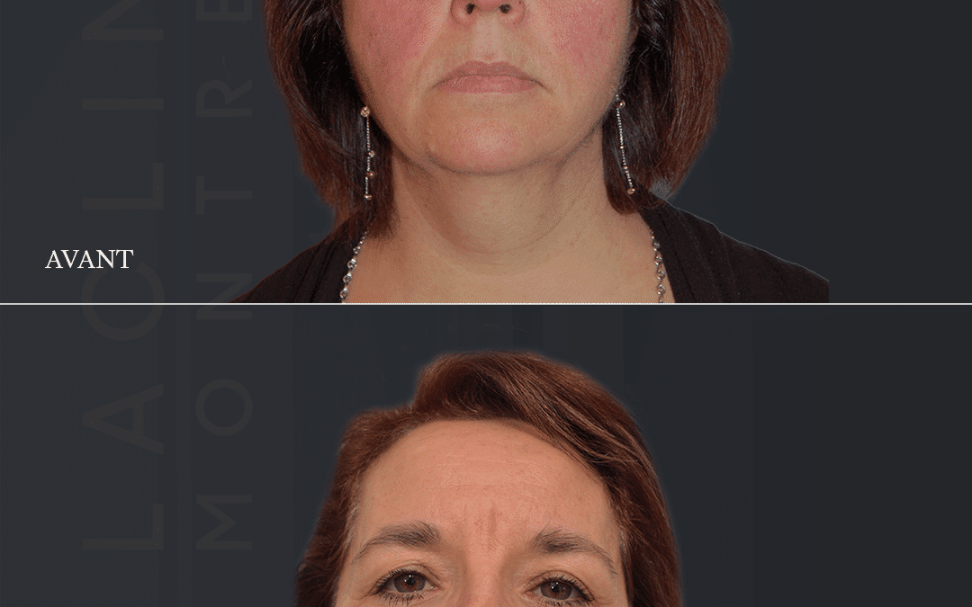 Lifting visage