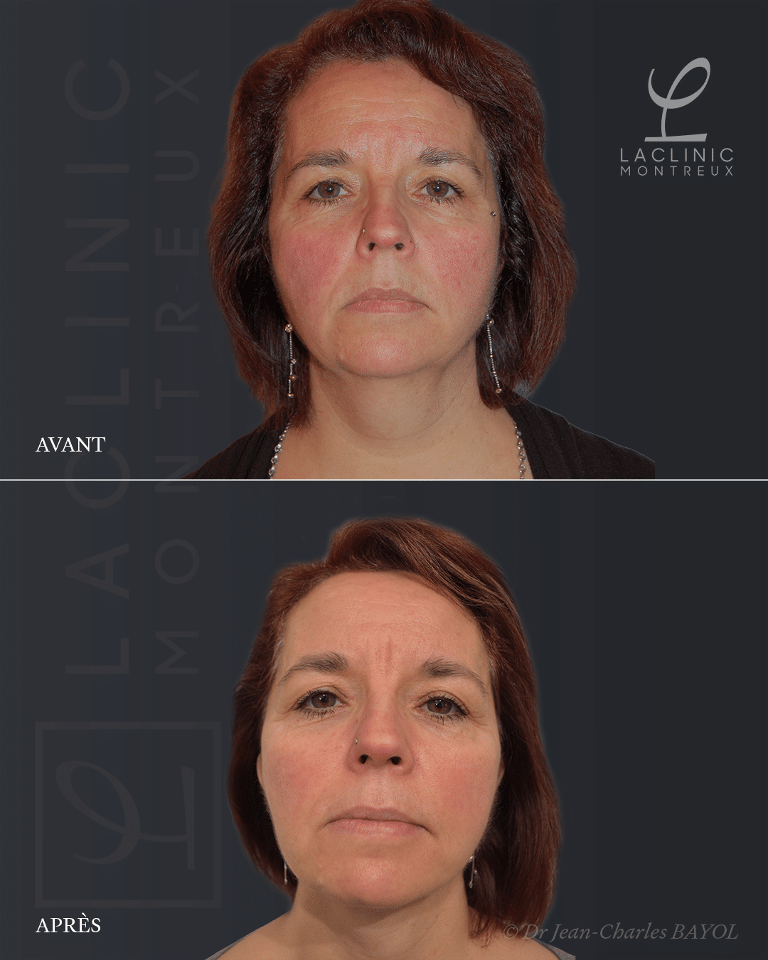 Deep plane facelifting avant-après