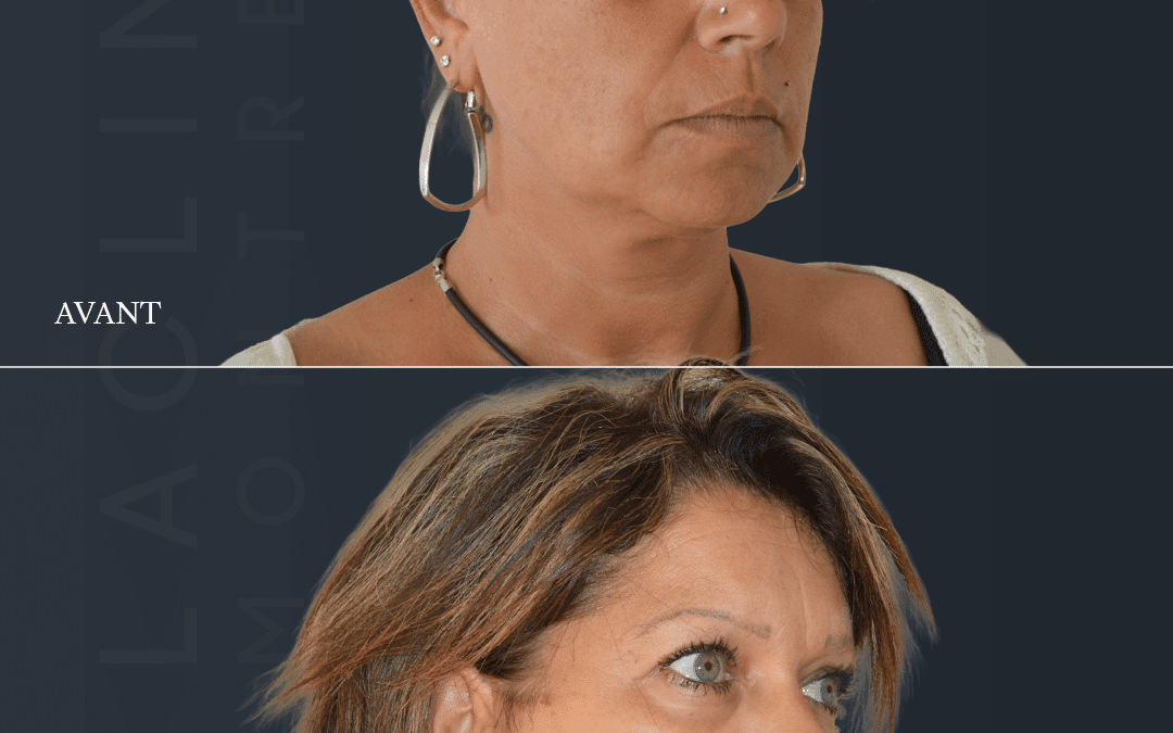 Lifting visage