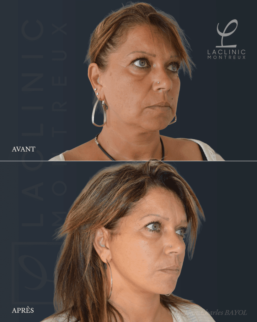 Deep plane facelift lifting du visage avant-apres