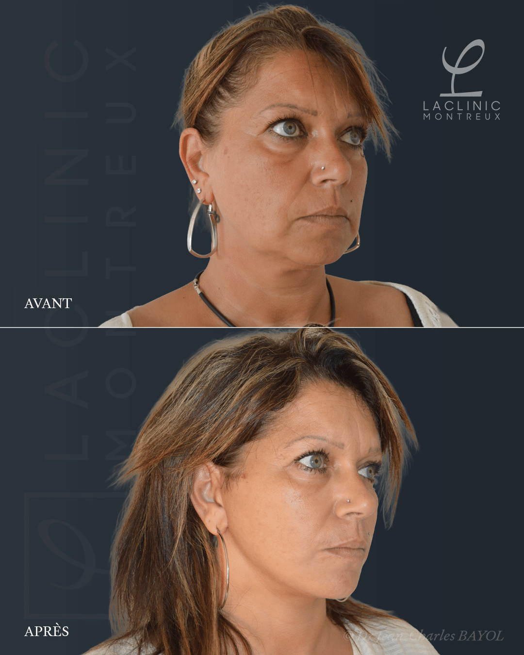 Deep plane facelift lifting du visage avant-apres