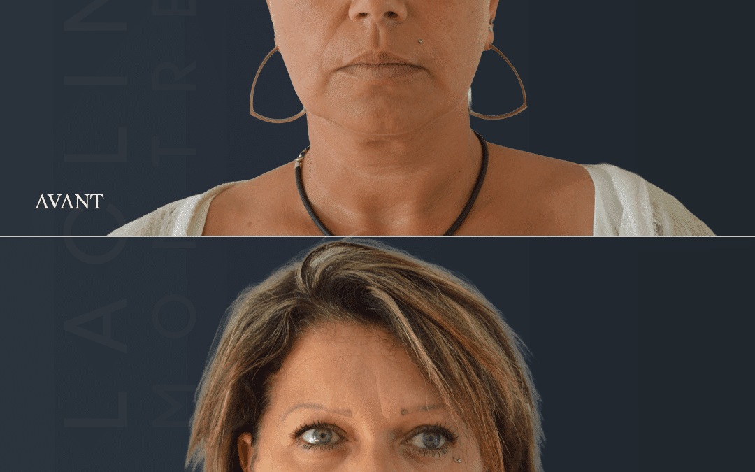 Lifting visage