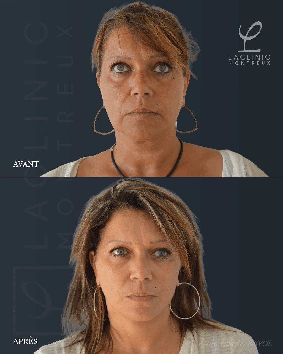 Deep plane facelift lifting du visage avant-apres
