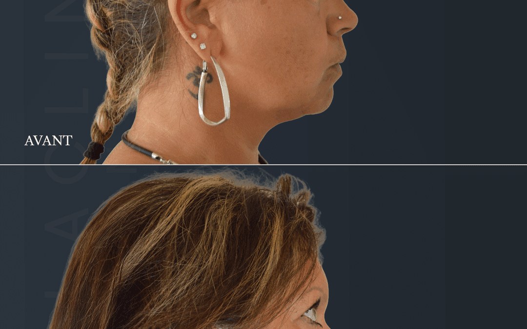 Lifting visage
