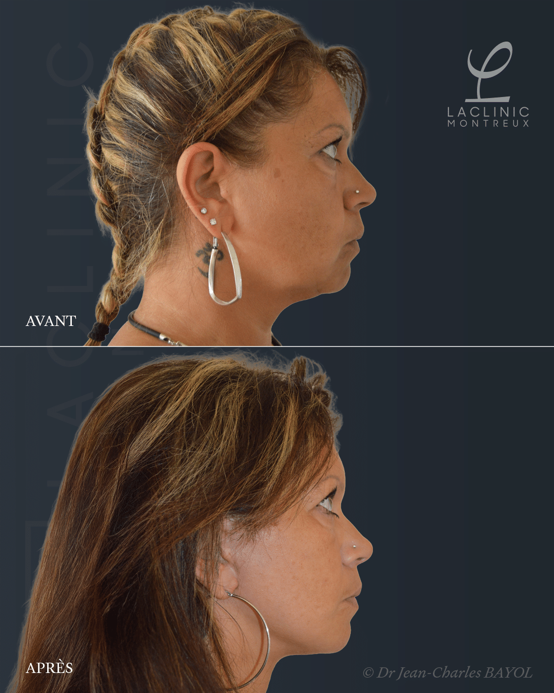 Deep plane facelift lifting du visage avant-apres