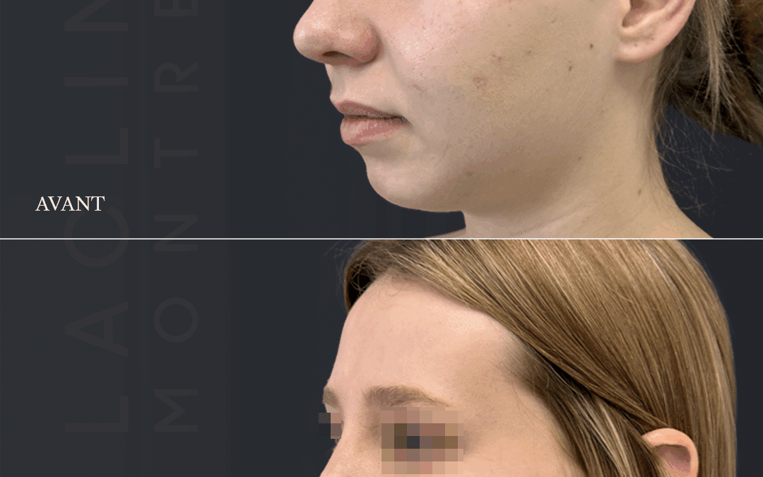 Rhinoplastie