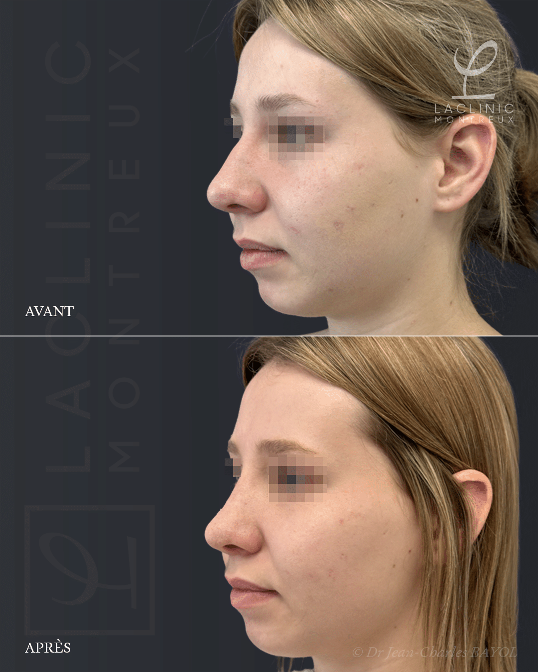 Rhinoplastie avant-après