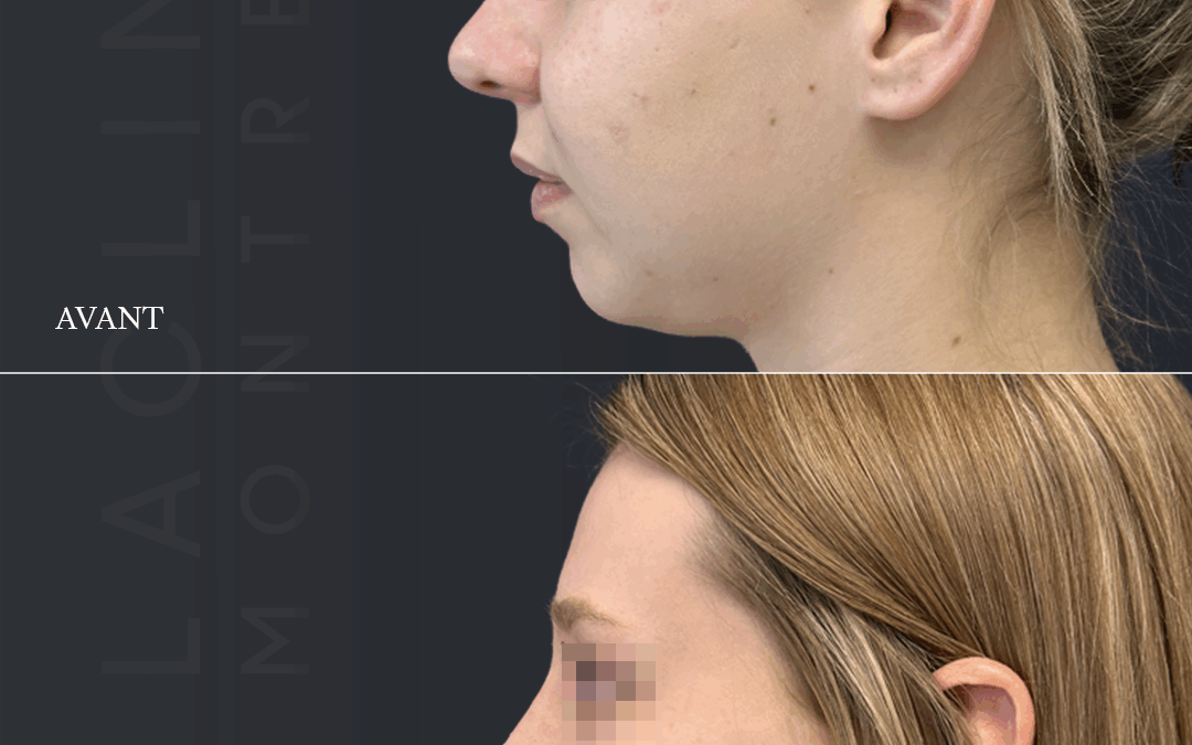 Rhinoplastie