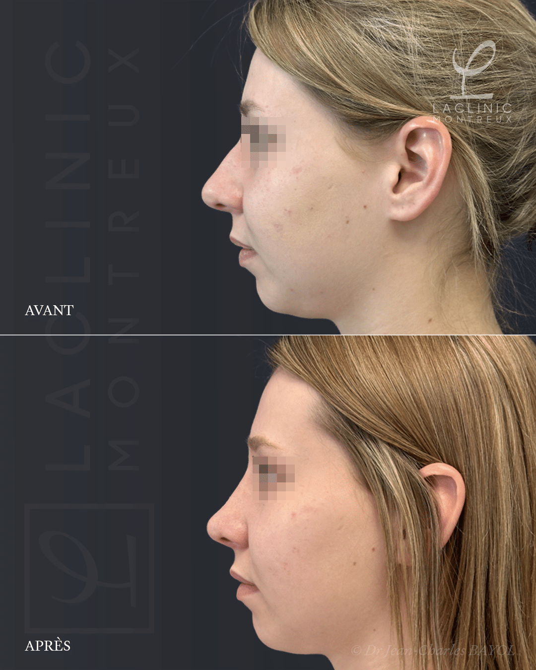 Rhinoplastie de conservation avant-après profil