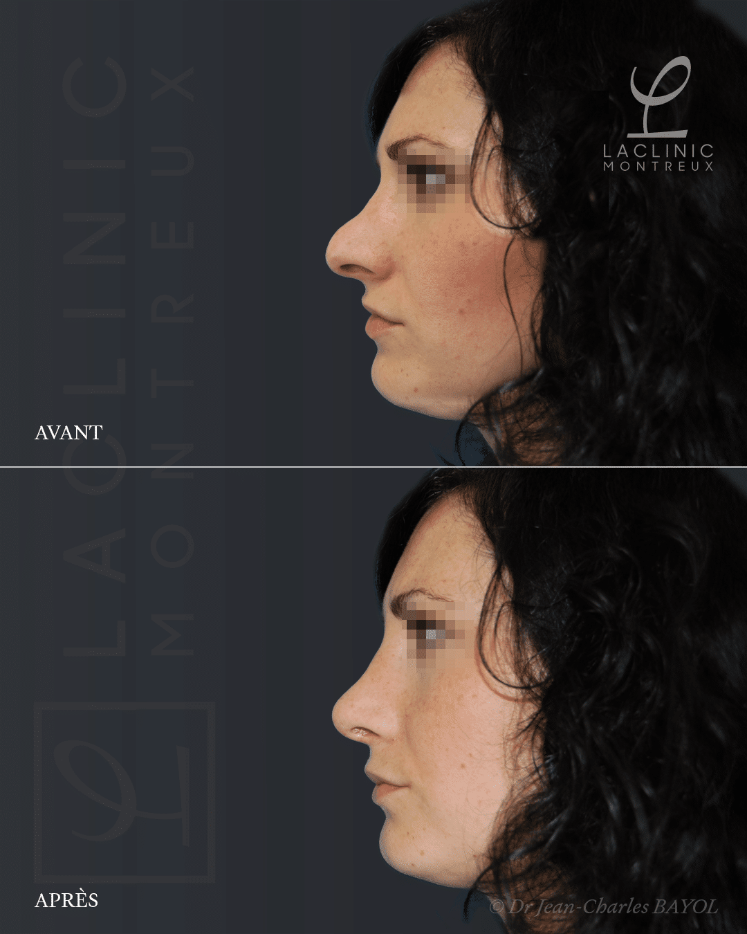 Rhinoplastie de conservation avant-apres