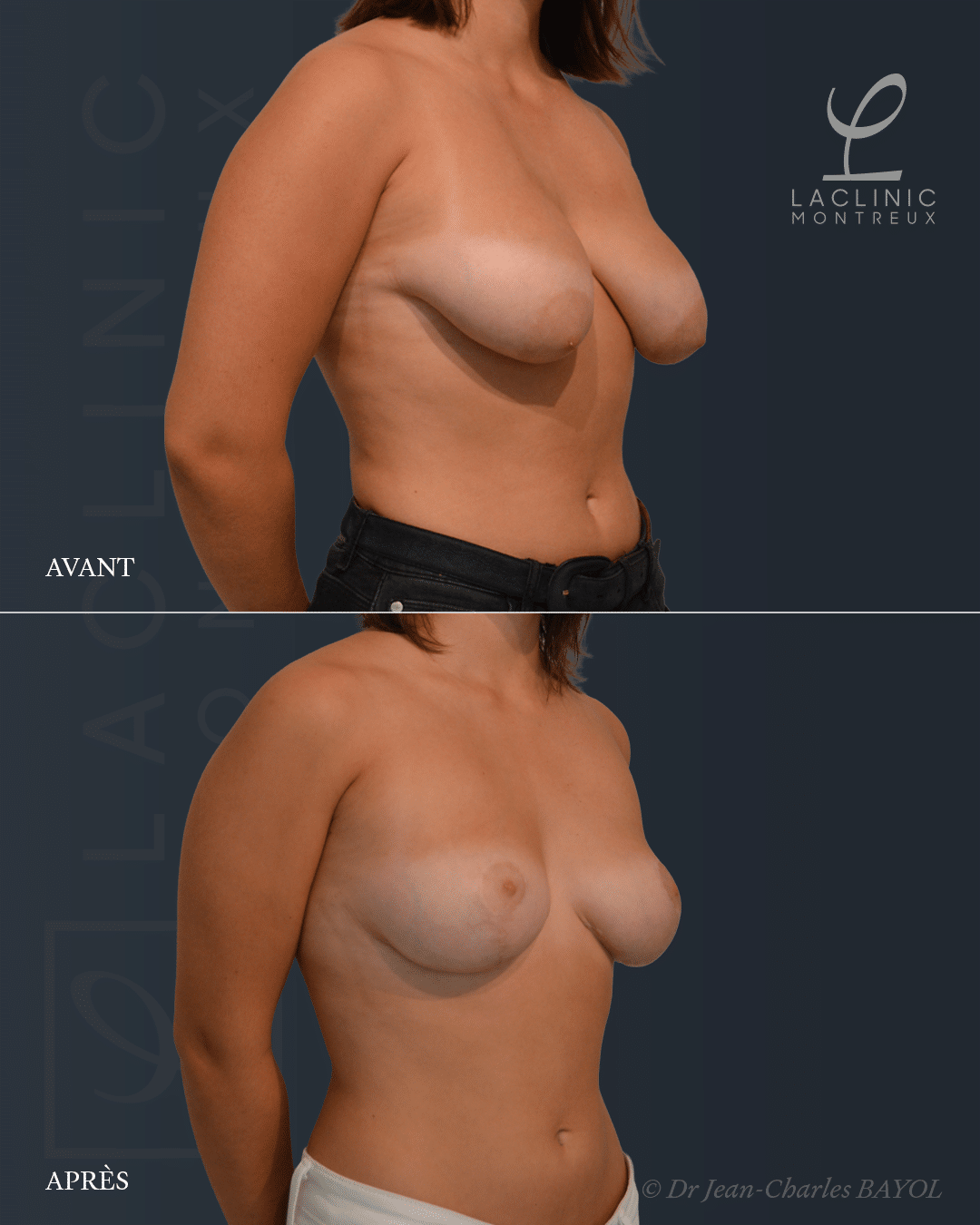Mastopexie correction de ptose mammaire lifting des seins