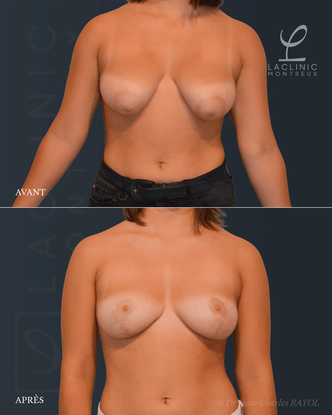 Mastopexie correction de ptose mammaire lifting des seins