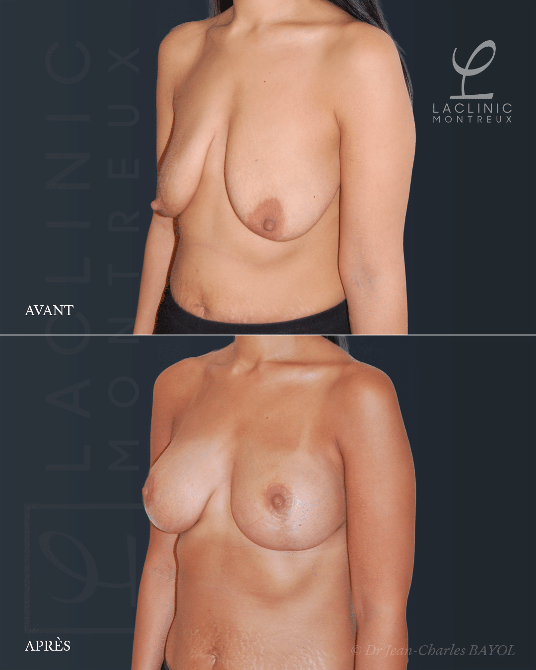 Mastopexie correction de ptose mammaire lifting des seins