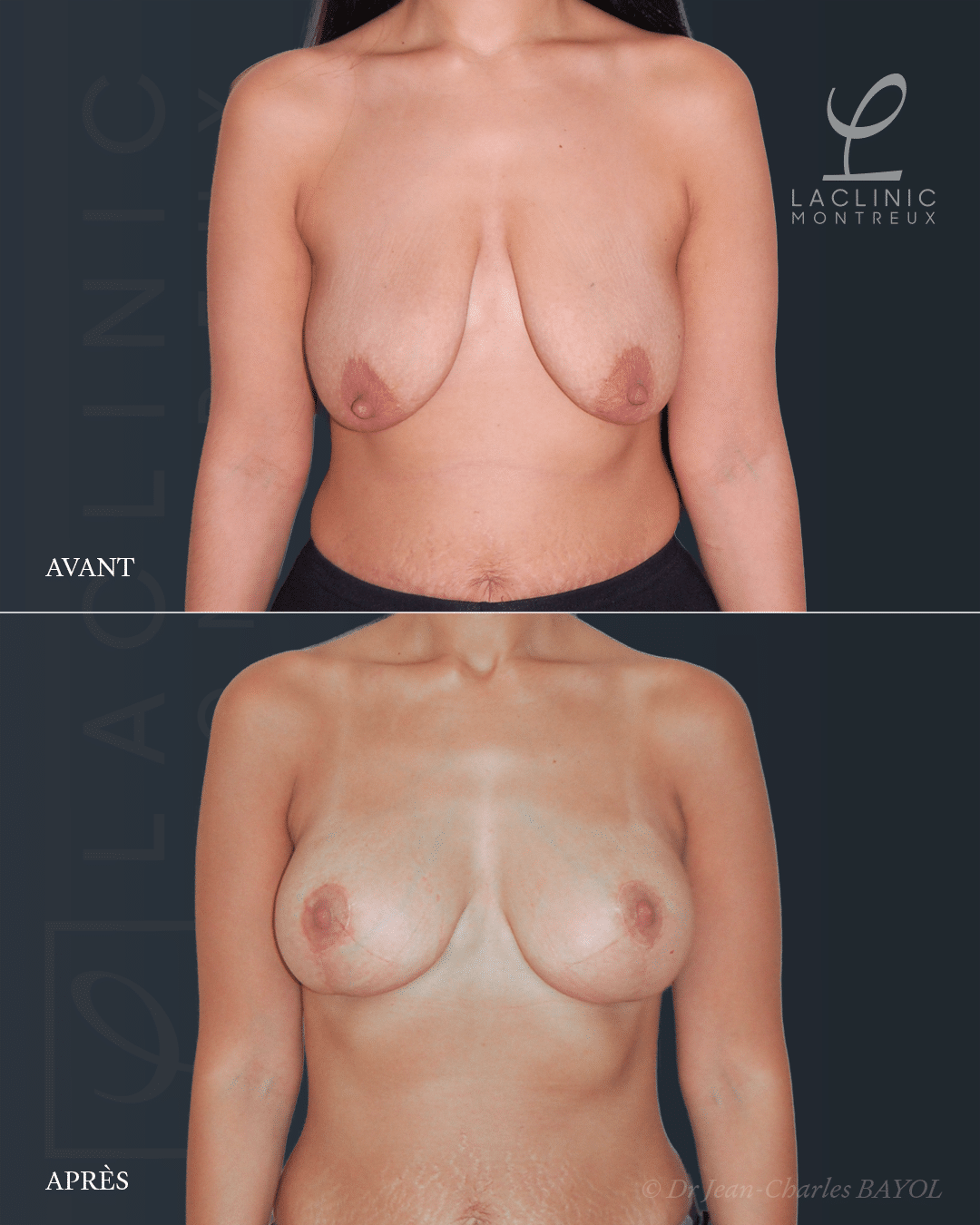 Mastopexie correction de ptose mammaire lifting des seins
