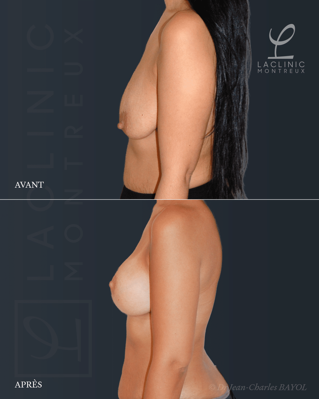 Mastopexie correction de ptose mammaire lifting des seins