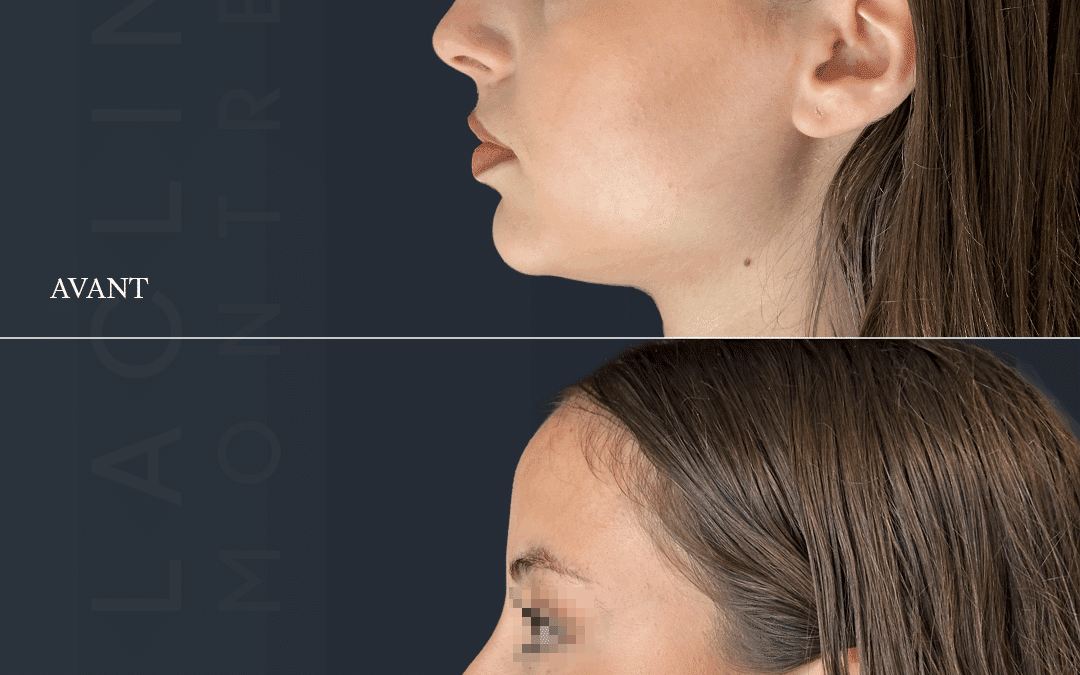 Rhinoplastie