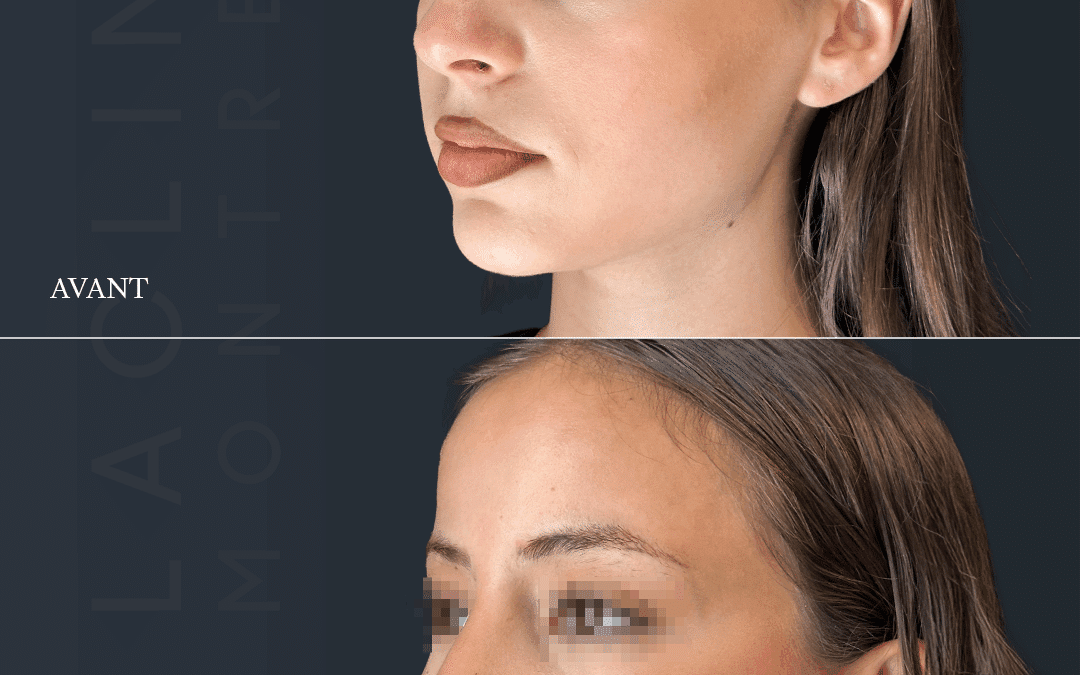 Rhinoplastie