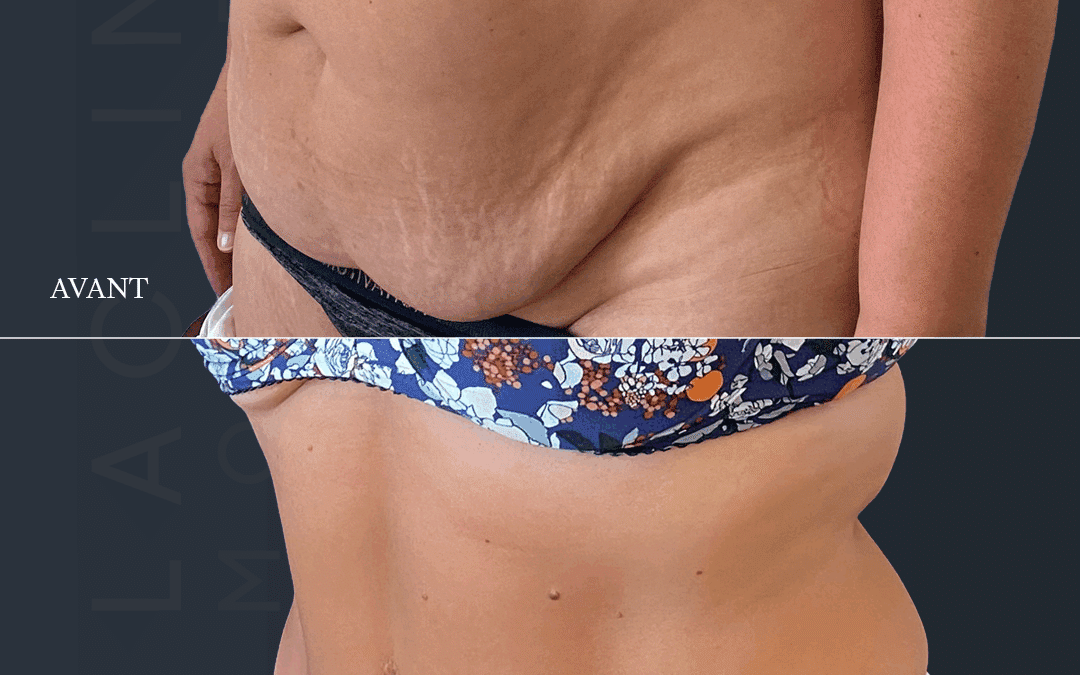Abdominoplastie