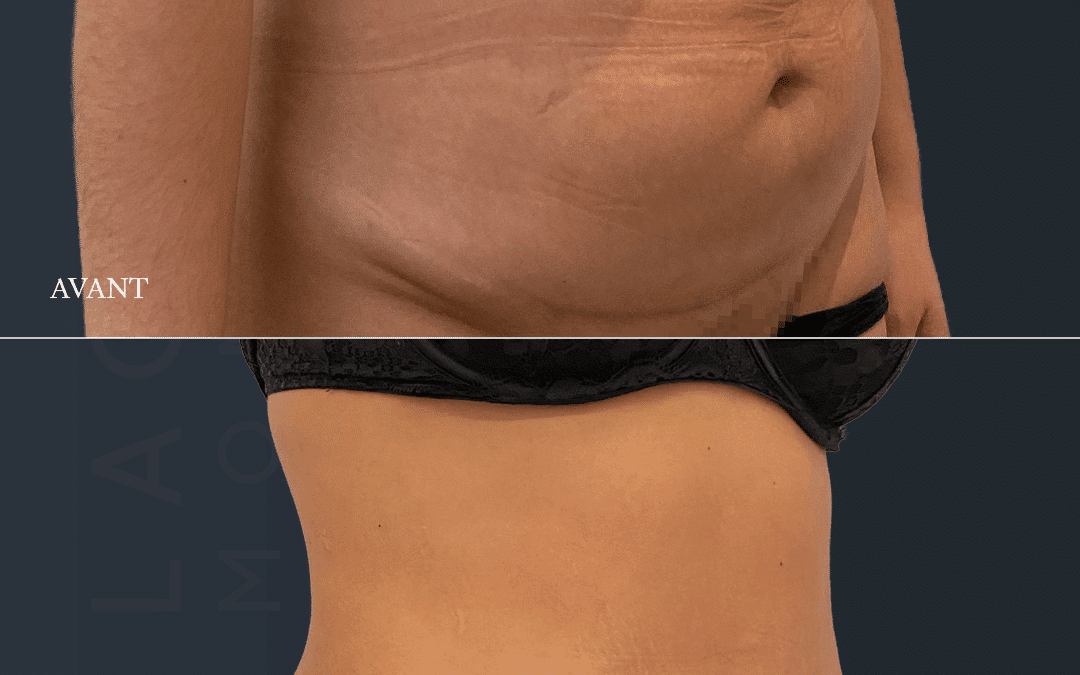 Abdominoplastie