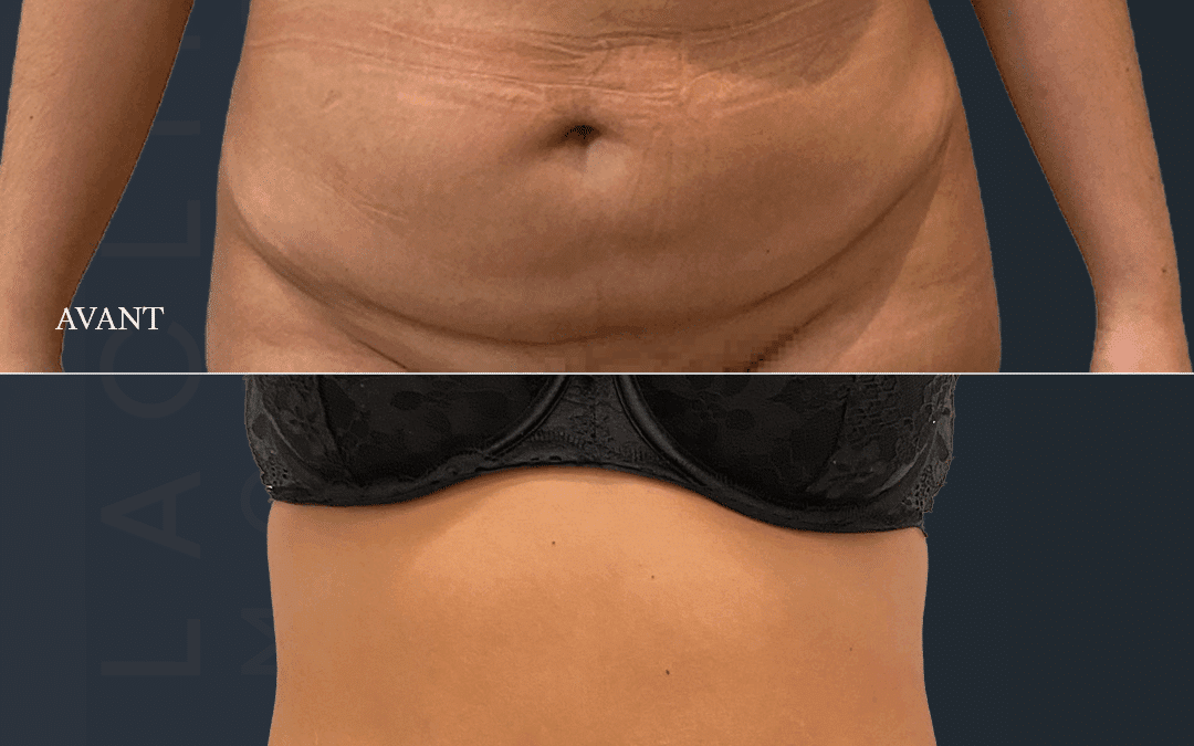Abdominoplastie