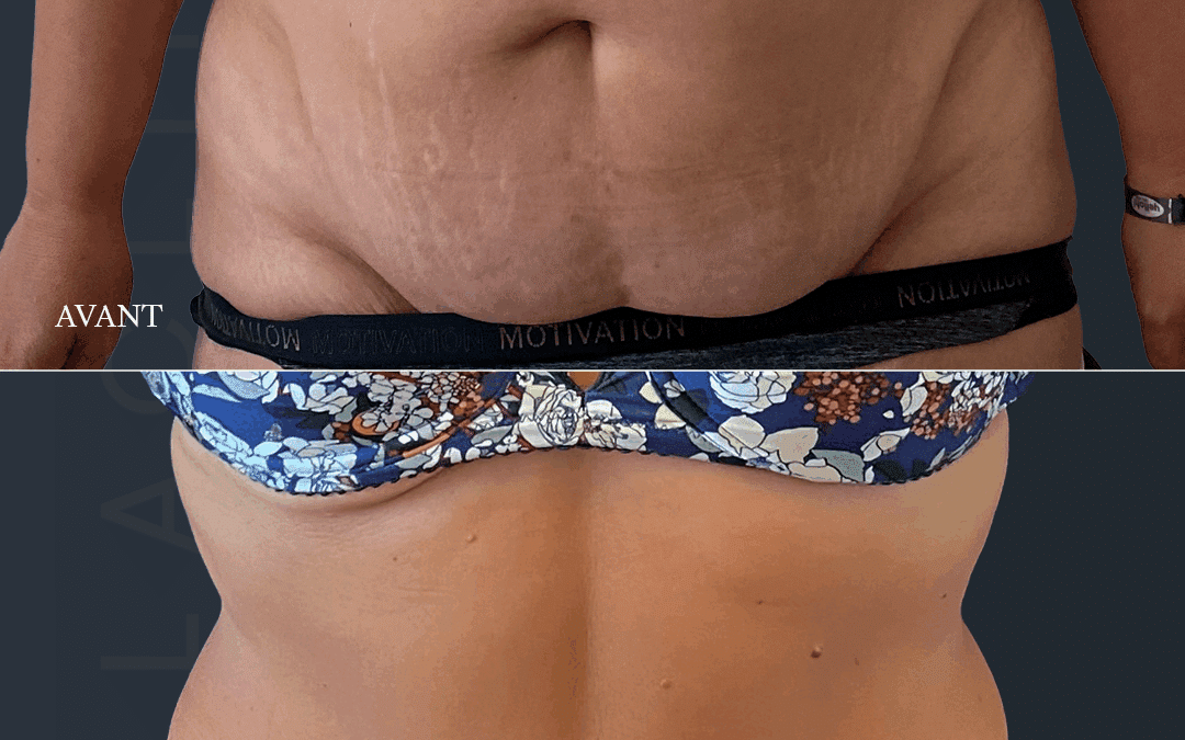 Abdominoplastie