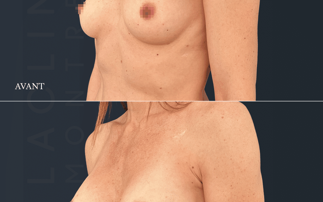 Augmentation mammaire