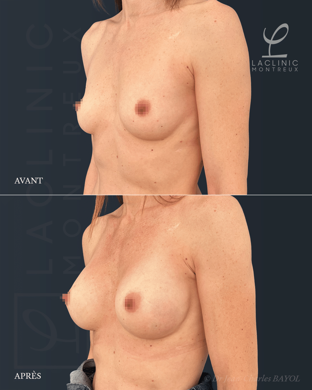 augmentation mammaire augmenter le volume des seins