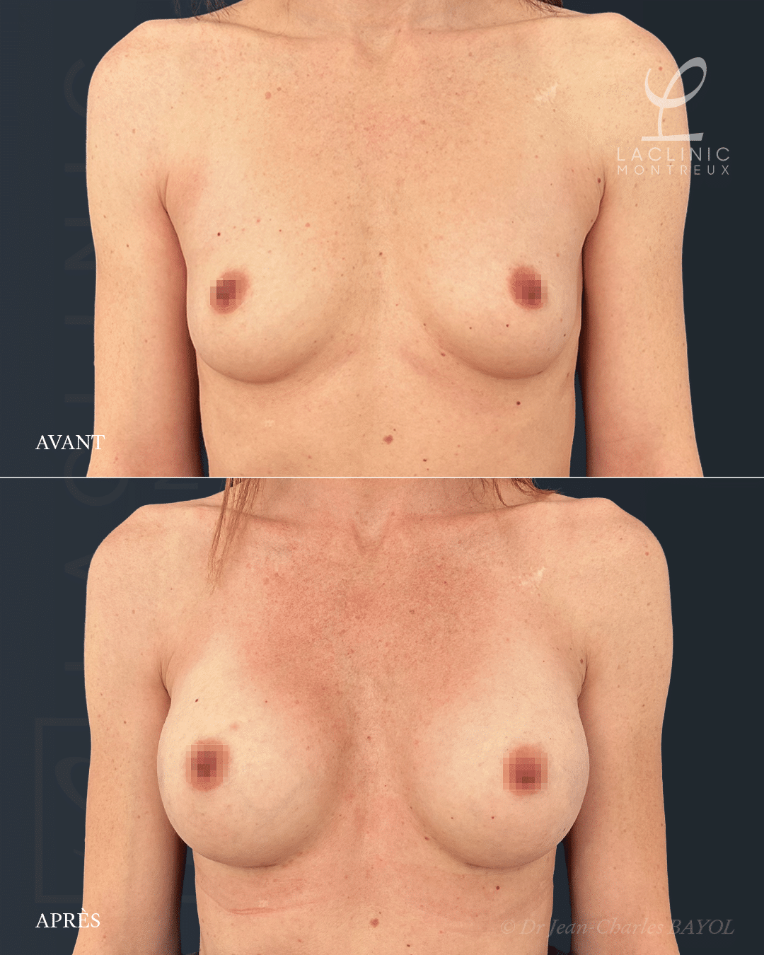 augmentation mammaire agrandir les seins