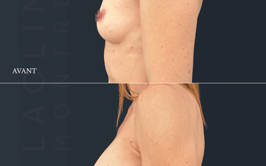 Augmentation mammaire