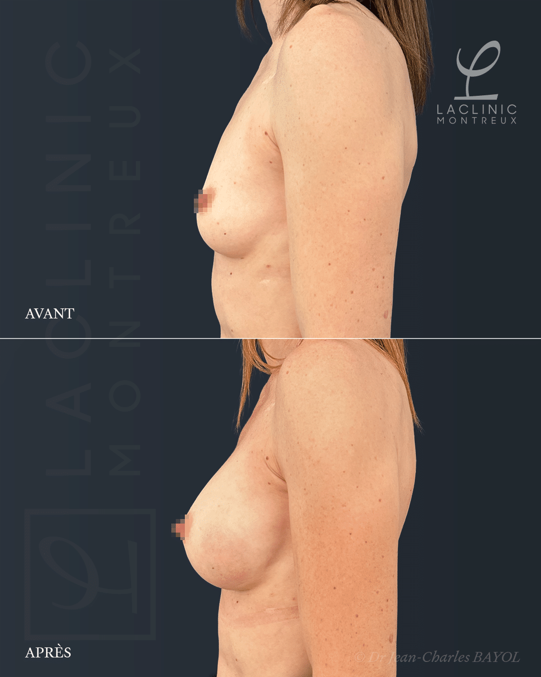 augmentation mammaire augmenter le volume des seins plus gros