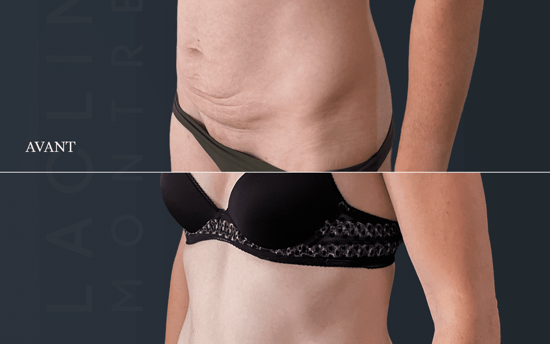 Abdominoplastie