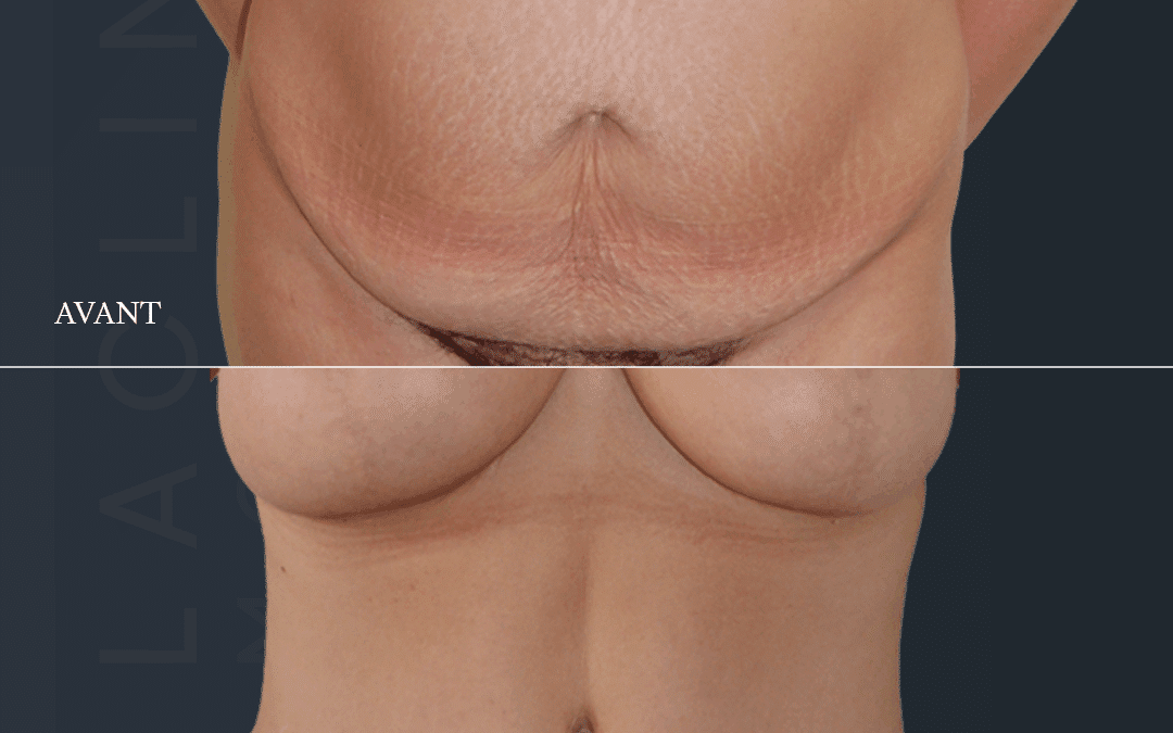 Abdominoplastie