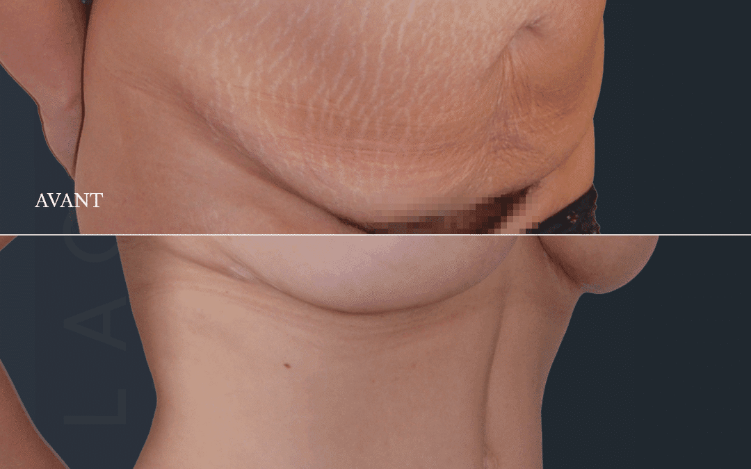 Abdominoplastie