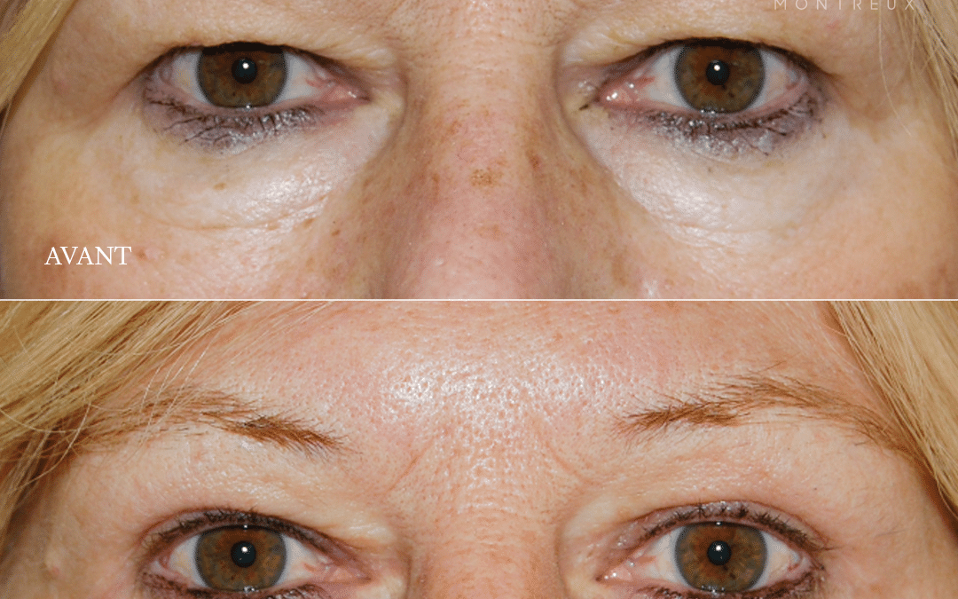 Blépharoplastie