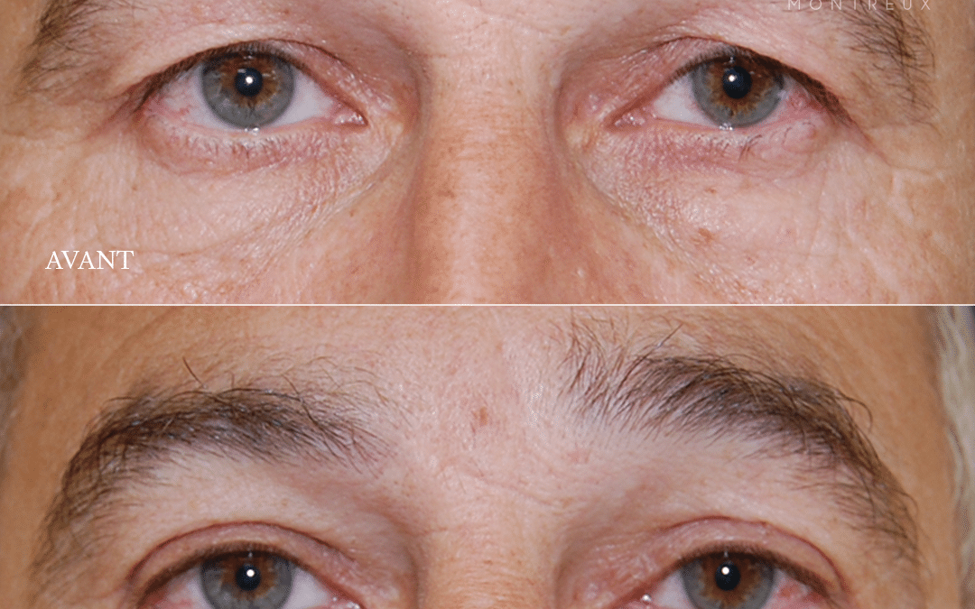 Blépharoplastie