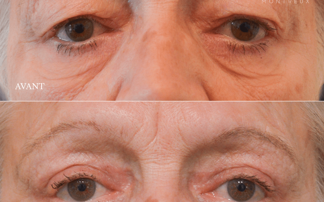 Blépharoplastie