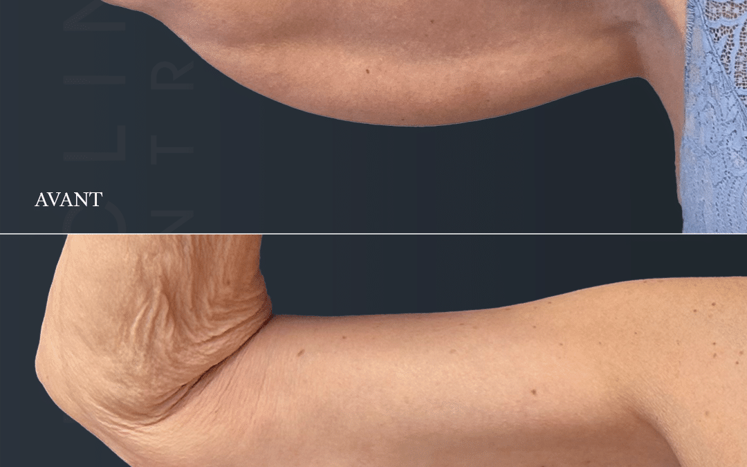 Brachioplastie