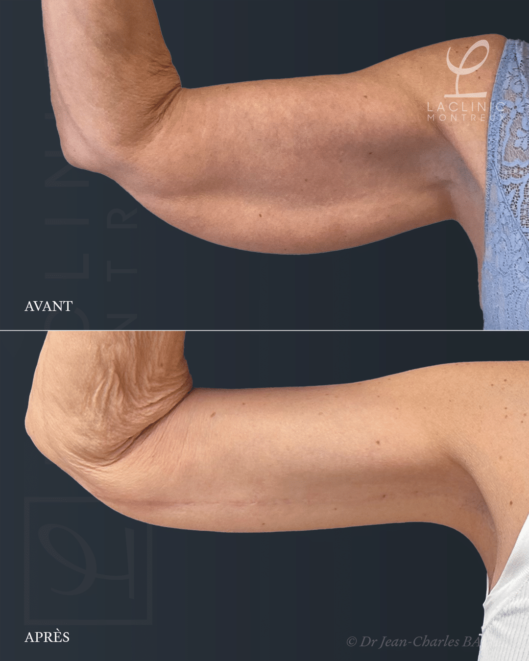 Brachioplastie, lifting des bras, chirurgie esthétique des bras