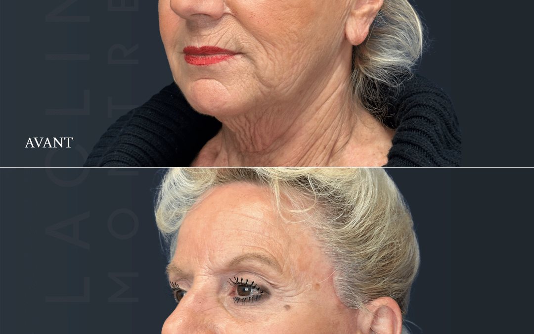 Lifting visage