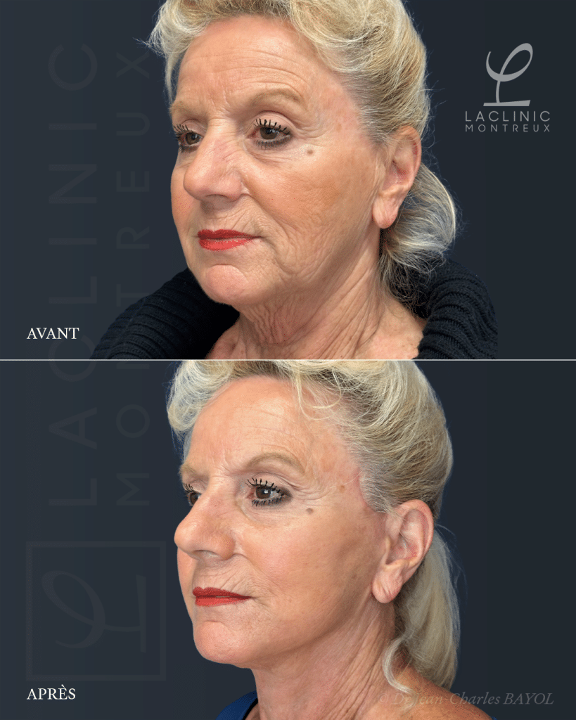 Avant-après un lifting du visage