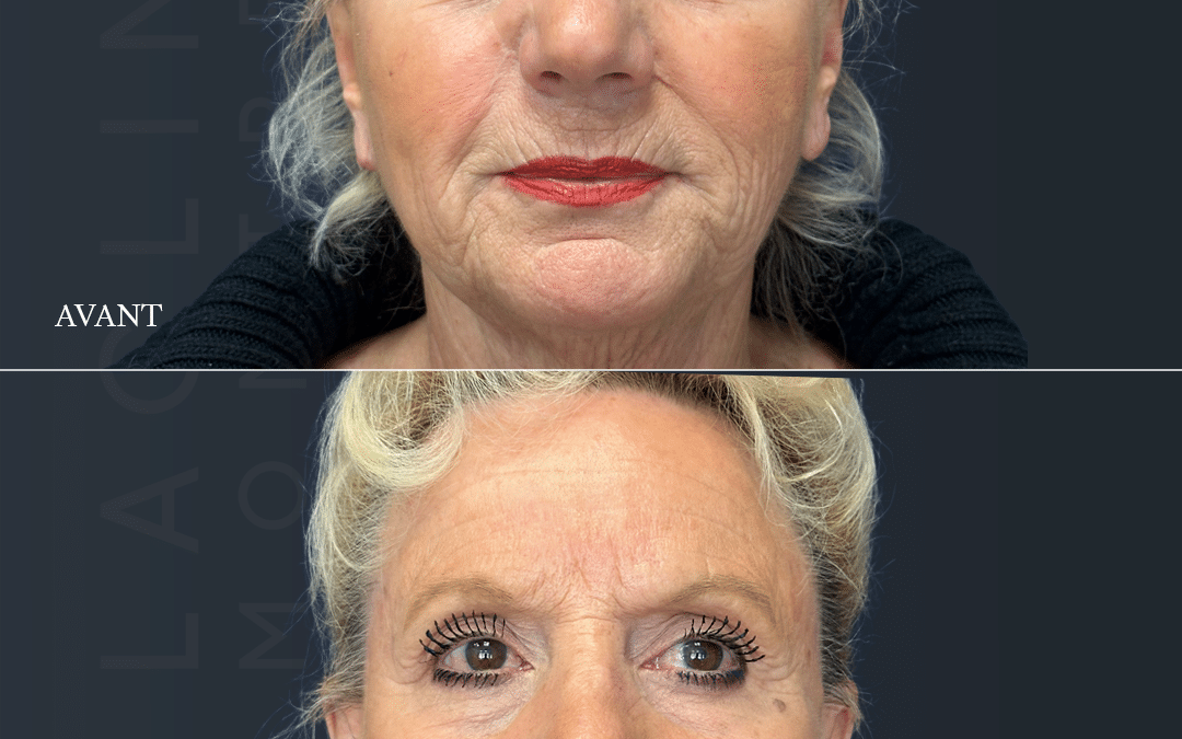 Lifting visage