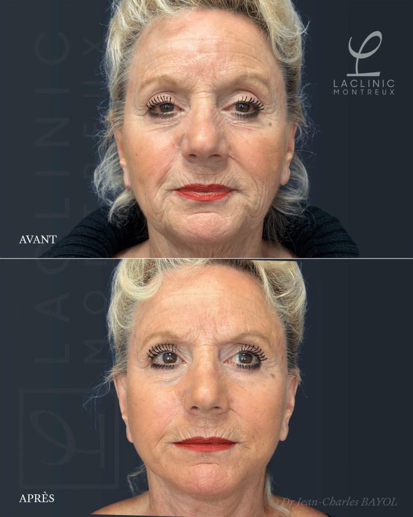 Avant-après un lifting du visage